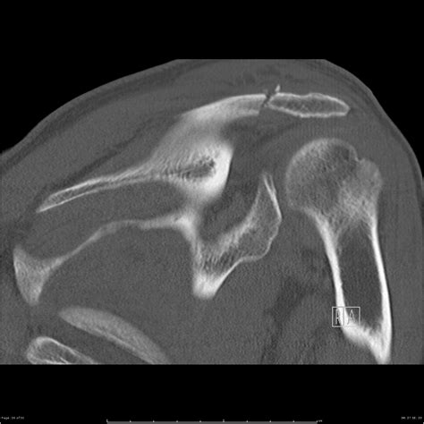 Acromial Fracture Image
