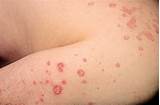 Images of Eczema Skin Disease Treatment
