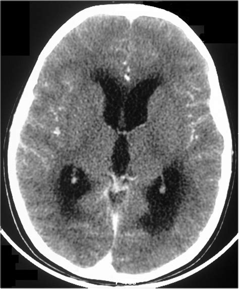 Contrast Enhanced Computed Tomography Scan Of Brain Showing