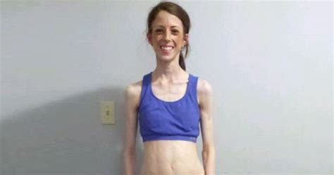 Severely Anorexic Womans Life Saved By Worried Gym Goers Staging An