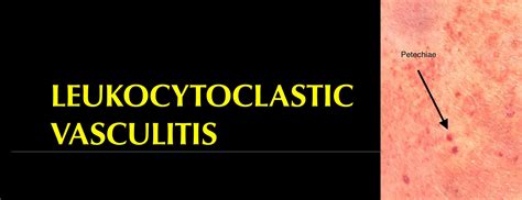 Leukocytoclastic Vasculitis Rash