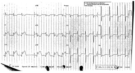 Electrocardiographic Manifestations Acute Posterior Wall Myocardial