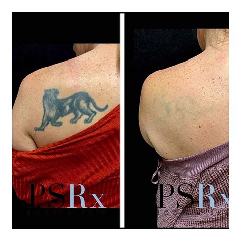 Tattoo Removal Chicago Psrx Body And Skin