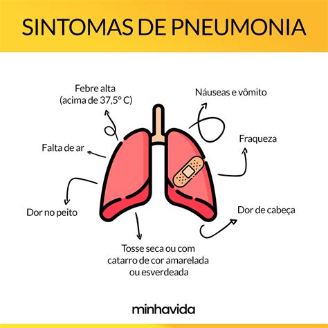 Pneumonia // mayo clinic, 2020. Pneumonia: o que é, sintomas, tratamento e é contagiosa ...