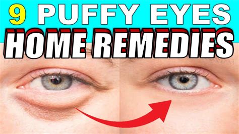 9 Quick Home Remedies To Treat Puffy Eyes And Bags Naturally Causes Of Puffy Eyes Youtube