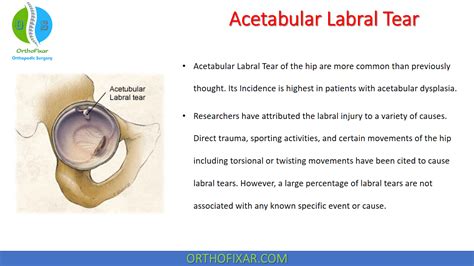 Acetabular Labral Tear Orthofixar