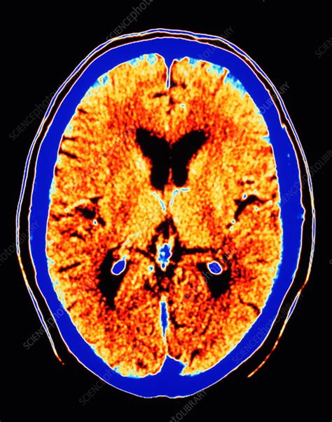 Ct Scan Of Section Through Healthy Brain Stock Image P3320269