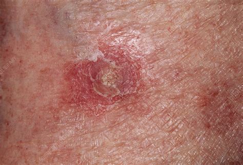 Skin Cancer Stock Image M1310382 Science Photo Library