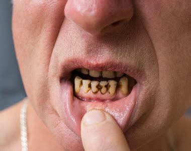Meth Mouth How Methamphetamine Use Affects Dental Health Brilliant Dentistry