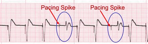 Ventricular Pacemaker Rhythm Strip