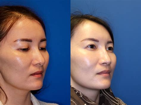Nose Surgery Before And After Photos Patient 237 San Francisco Ca