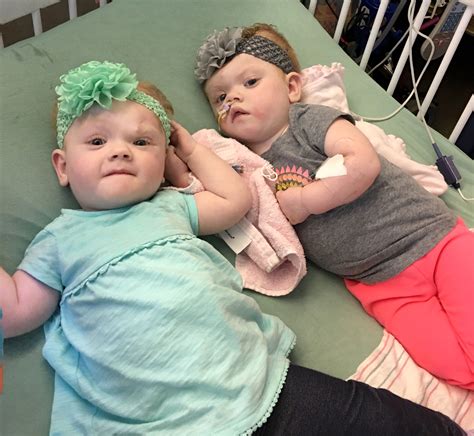 Formerly Conjoined Twins Thriving Five Months After Surgery