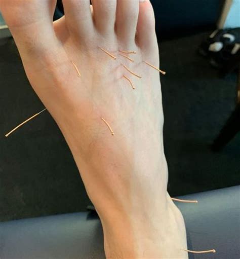 Dry Needling Of The Feet A Podiatrists View Gen Physio