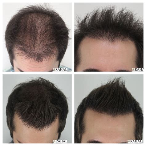 Before After Hair Loss After Baby Waiting List Hair Transplant