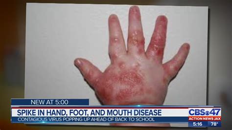 Cases Of Hand Foot And Mouth Disease On The Rise Local Doctor Says