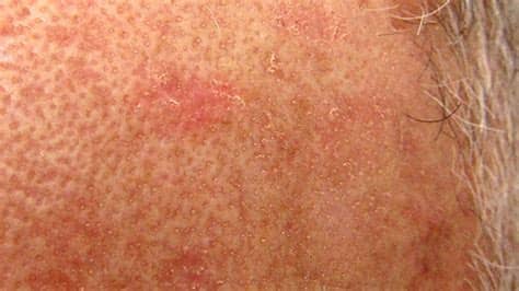 Reddit has some pretty strong opinions. Actinic Keratosis: Causes, Symptoms, and Treatment