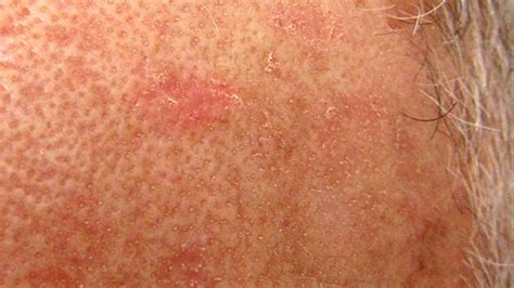 Discolored Skin Patches Pictures Causes And Treatments