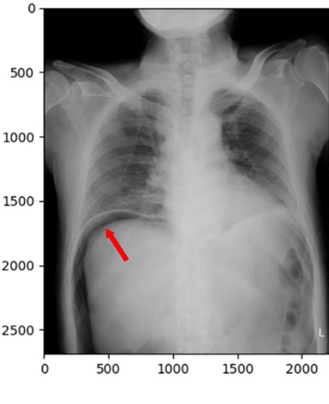 Frontal Chest X Ray Images Of A A Negative Normal Case And B A