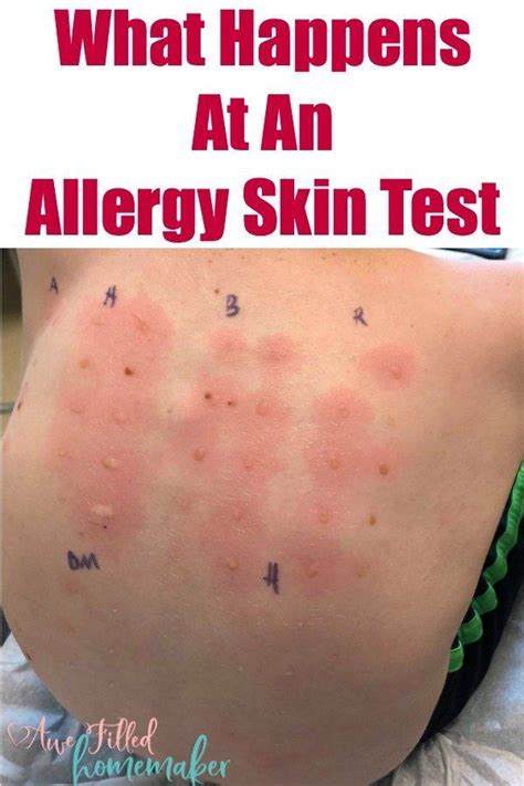 What Happens At An Allergy Skin Test Allergies Women Nutrition