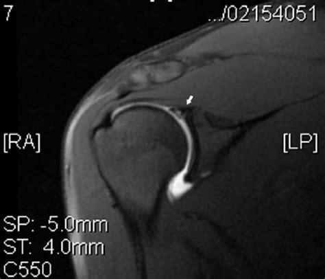 Synovial ball and socket joint. A T2 coronal MRI of the right shoulder with white arrow ...