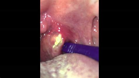 Huge Tonsil Stone Youtube