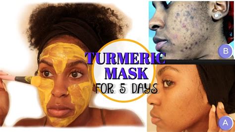 Turmeric Face Mask Before And After Pictures