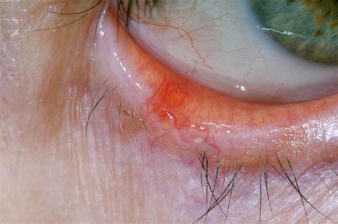 Lesion On The Lower Eyelid Photograph By Dr P Marazziscience Photo