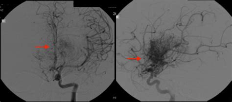 Cureus An Unusual Presentation Of Arteriovenous Malformation In A