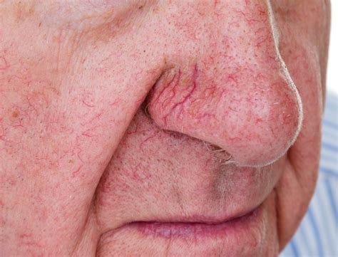 Broken Capillaries Causes And Treatment Skin Clinic Australia