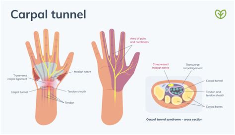 Carpal Tunnel Syndrome Exercises Fullscript