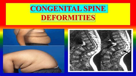 Congenital Spine Deformities Youtube