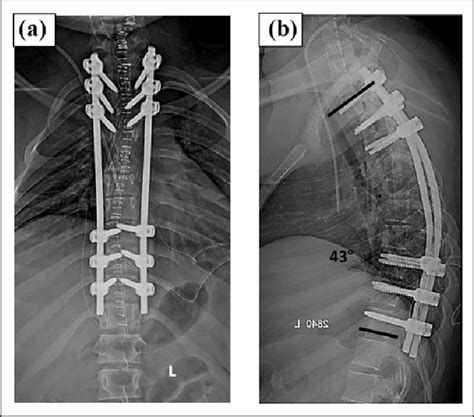 Plain Radiograph Showing Posterior Spinal Instrumented Fusion With