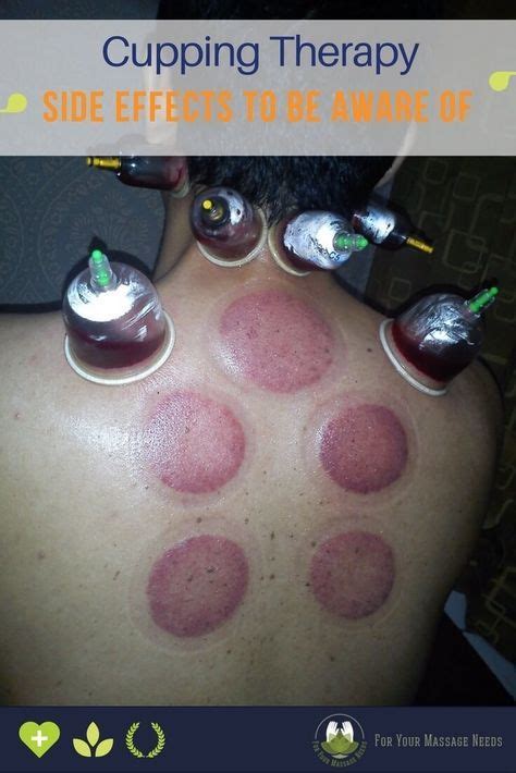 If Youre Interested In Cupping You Should Be Aware Of Cupping Therapy Side Effects I Explain