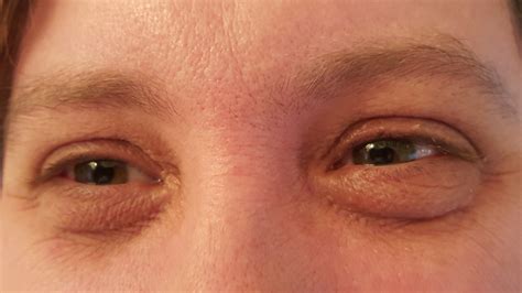 Related Keywords And Suggestions For Hypothyroidism Bags Under Eyes