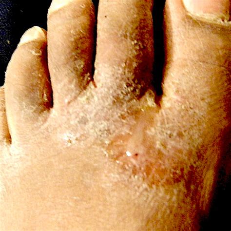 Fungal Nail Infections Treatment For Foot Fungus Or Toenail
