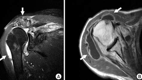 What Does Arthritis Look Like On An MRI