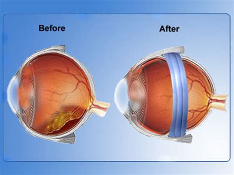 Cataract Surgery Cost In Kochi Best Squint Treatment In Kochi