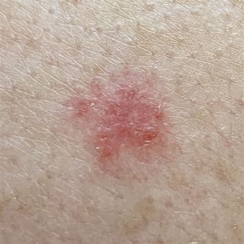 Superficial Basal Cell Carcinoma Early Stages