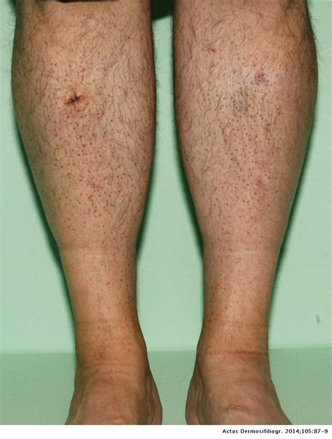 Papular Mycosis Fungoides On The Legs A Case Report Actas Dermo