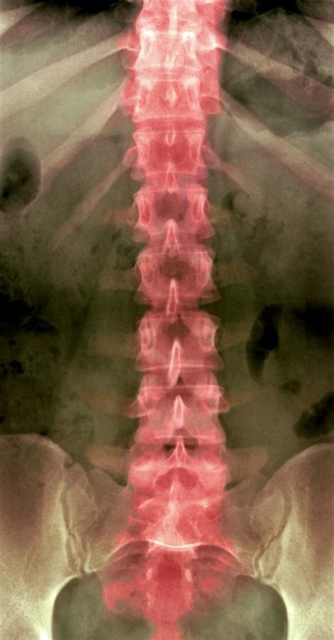 Normal Lumbar Spine X Ray Photograph By Du Cane Medical Imaging Ltd