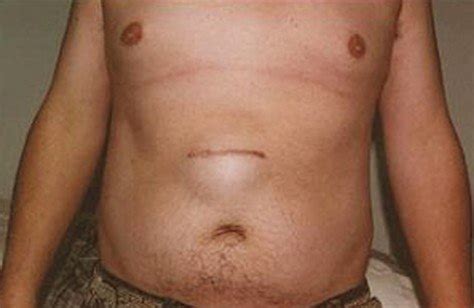 At times the lump isnt noticeable. Epigastric Hernia - Pictures, Symptoms, Treatment, Causes