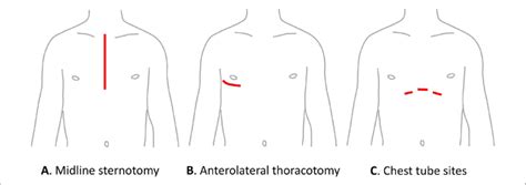 Commonly Used Incision Sites For Cardiac Surgery Download Scientific