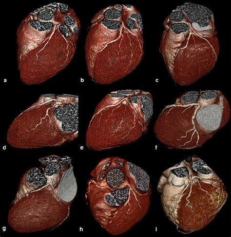 Jan 02, 2013 · arteries or veins from elsewhere in the patients body are grafted (internal thoracic arteries, radial arteries and saphenous) to the coronary arteries to bypass atherosclerotic narrowings and improve the blood supply to the coronary circulation supplying the myocardium (heart muscle). Number Of Diagonal Arteries / 3rd Diagonal Vessel Of The ...