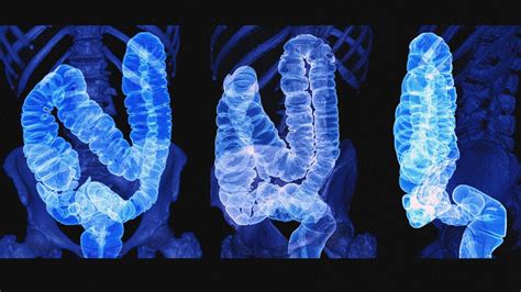 Colon Cancer Symptoms Stages Causes And Treatment