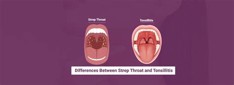 Differences Between Strep Throat And Tonsillitis