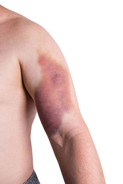 Bruised Arm Stock Photos Pictures And Royalty Free Images Istock