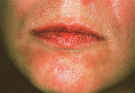 Secondary Syphilis Rash Photograph By Cnriscience Photo Library
