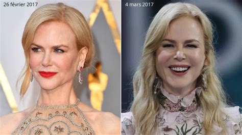 Nicole Kidman Et La Chirurgie Esthétique - PHOTOS Nicole Kidman méconnaissable : en une semaine son visage a