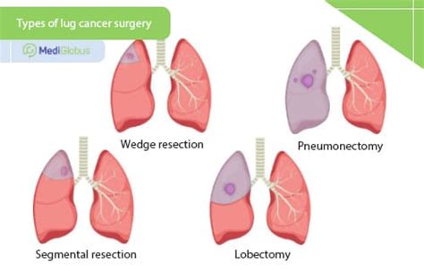 Surgery For Lung Cancer Mediglobus
