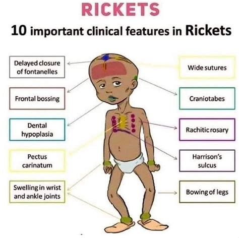 Rickets Clinical Features Medizzy